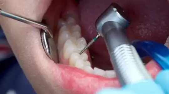 root canal treatment