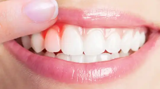 Gum Treatment in kanpur at Growing Smiles Dental Clinic in Kanpur