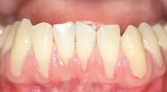 Gum Treatment in kanpur at Growing Smiles Dental Clinic in Kanpur
