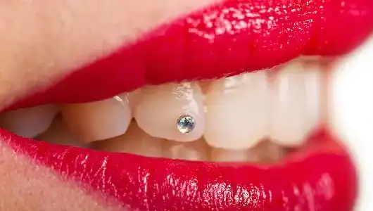 teeth jwellry in kanpur at growing smile dental clinic in kanpur