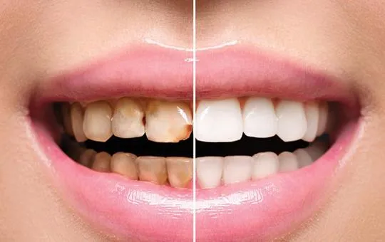 Full Mouth Rehabilitation in kanpur​