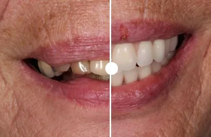 Full Mouth Rehabilitation in kanpur​