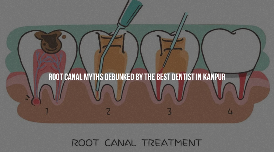 Root Canal Myths Debunked by the Best Dentist in Kanpur