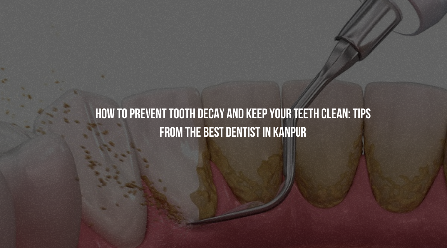 How to Prevent Tooth Decay and Keep Your Teeth Clean: Tips From the Best Dentist in Kanpur
