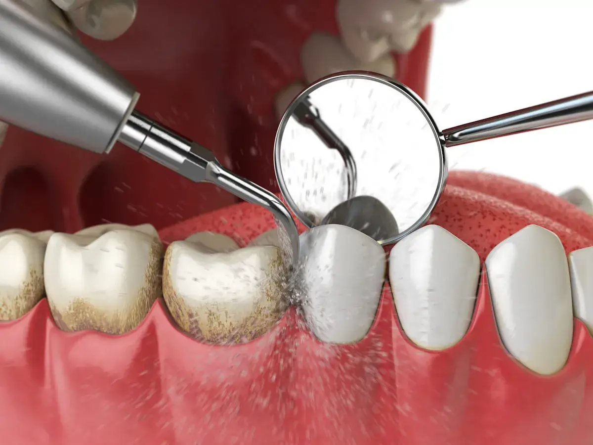 teeth cleaning in Kanpur