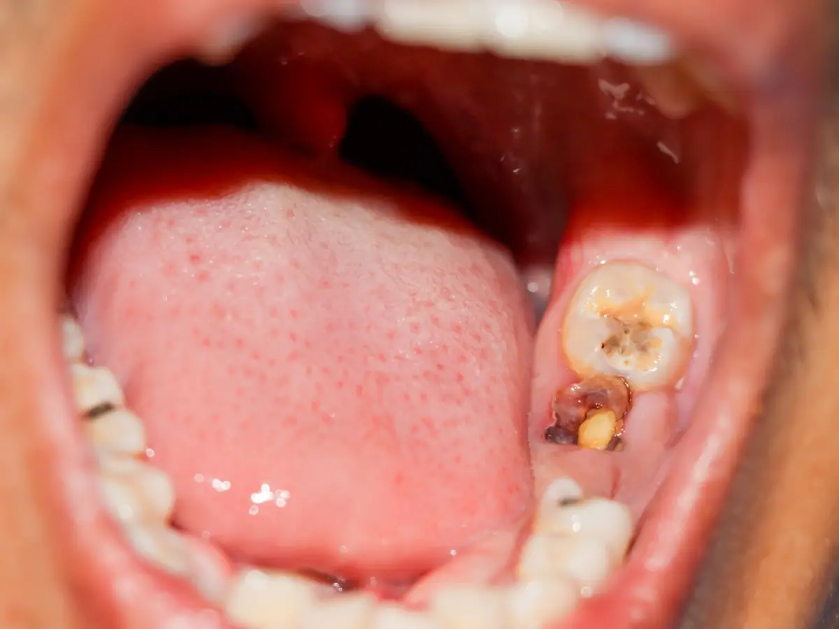 wisdom teeth removal in Kanpur